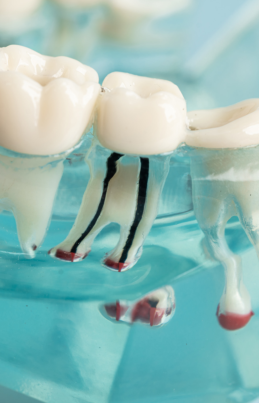 Ανώδυνη Ενδοδοντική Θεραπεία