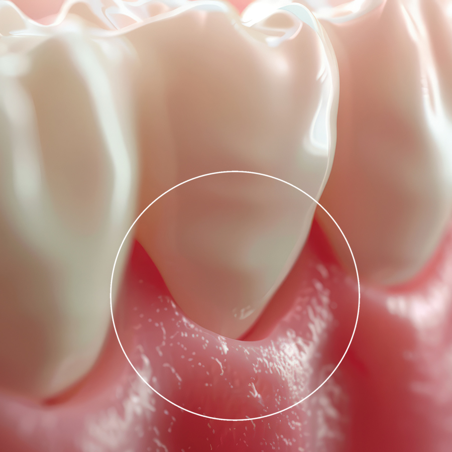 Ουλίτιδα – Περιοδοντίτιδα