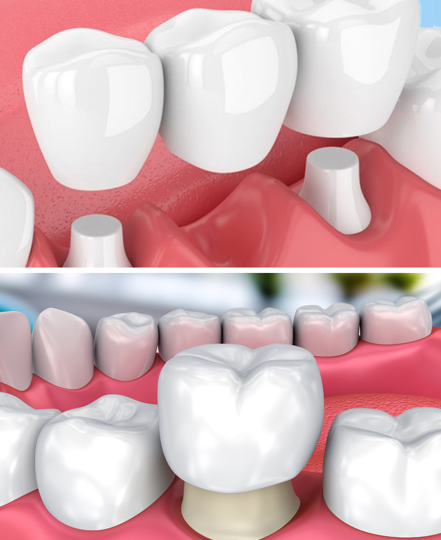 Στεφάνες & Γέφυρες